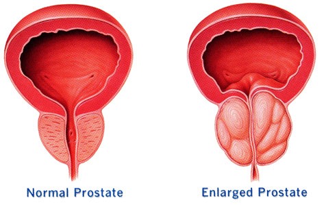 Предпазване на простатата 1